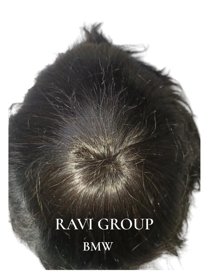 BMW men's toupee